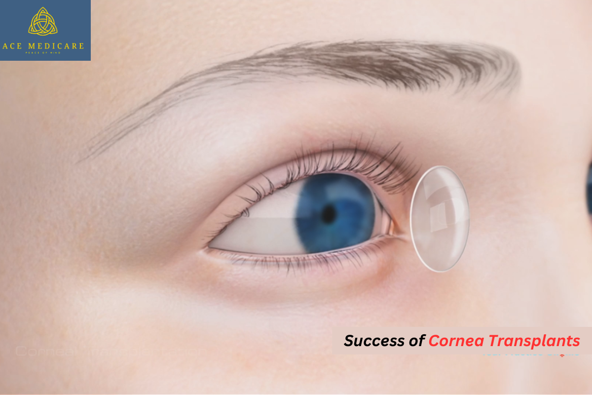 Reviving Vision: The Science and Success of Cornea Transplants